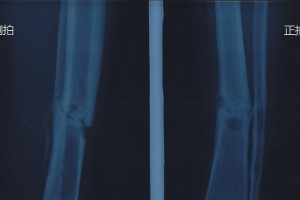 大腿错位恢复完全无需手术的时间周期（了解大腿错位恢复的关键和时间进程）