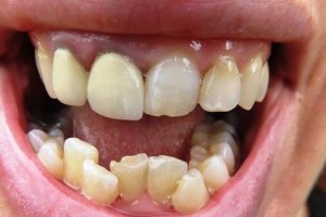 探索牙齿太尖的原因与解决方法（牙齿尖锐的形态特点及其对口腔健康的影响）